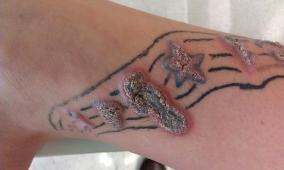 Type d'allergie au tatouage