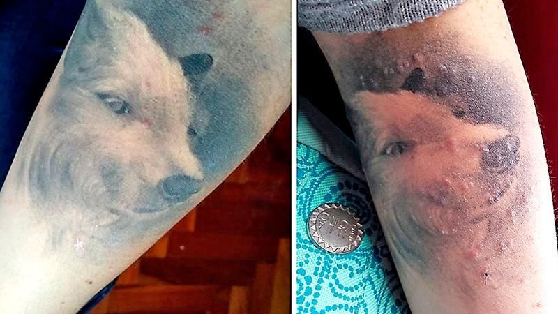 Une allergie au tattoo, site contaminé et infecté