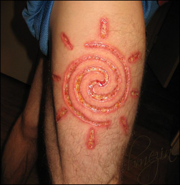 Tatouage infecté