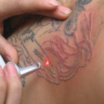 tatouage au laser