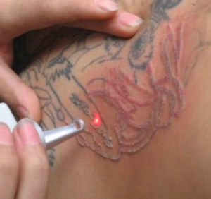 tatouage au laser